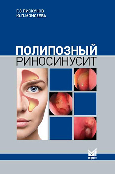 Полипозный риносинусит