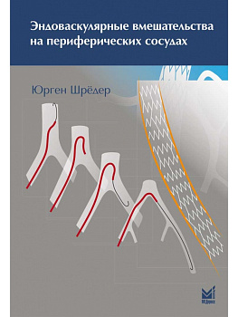 Эндоваскулярные вмешательства на периферических сосудах