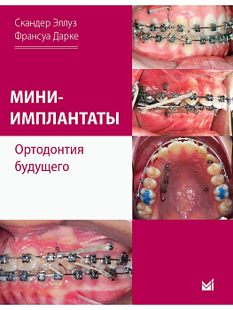 Мини-имплантаты. Ортодонтия будущего.